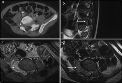 A sporadic pediatric case of a spinal dumbbell-shaped epithelioid malignant peripheral nerve sheath tumor with a novel germline mutation in SMARCB1: a case report and review of the literature